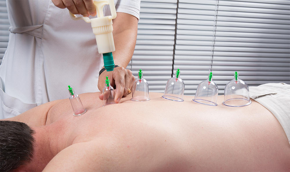 cupping